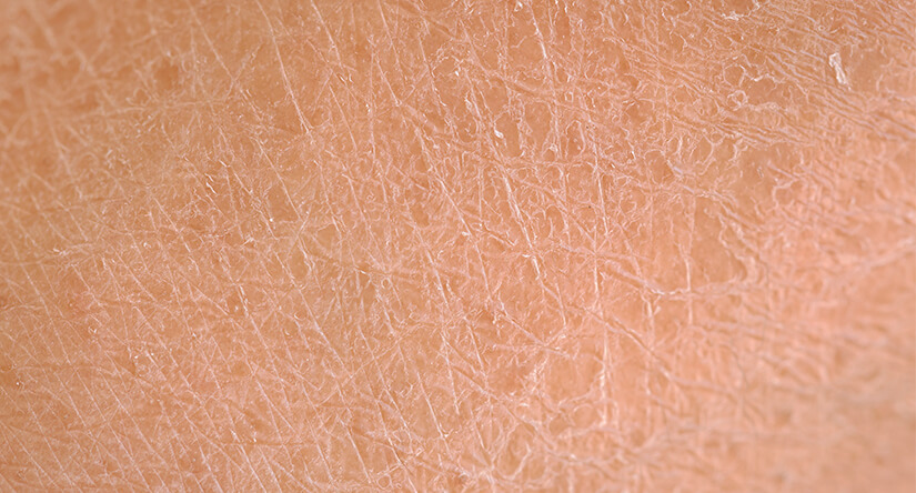 Extreme close-up van een zeer droge, schilferige huid met zichtbare barstjes.